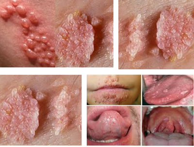 hpv herpes hiv