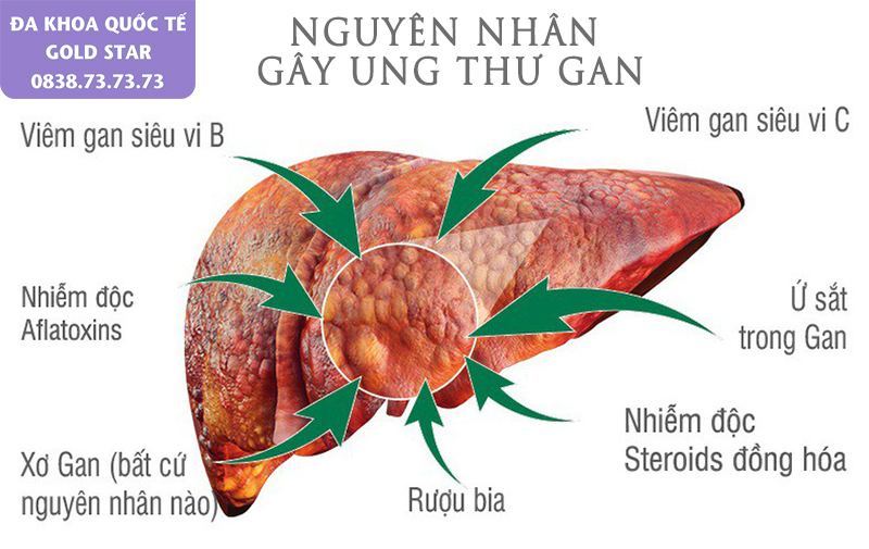 Cac nguyen nhan co the gay ung thu gan